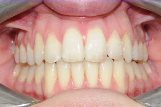 B&A Invisalign after 10