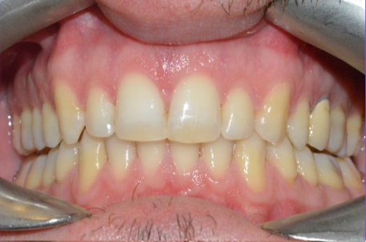 B&A Invisalign after 11