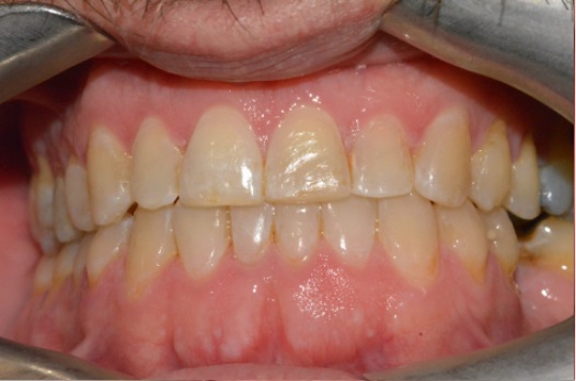 B&A Invisalign after 9