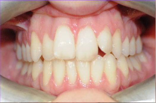 B&A Invisalign before 10