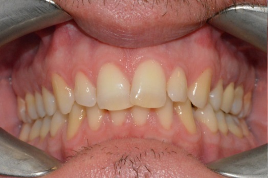 B&A Invisalign before 11