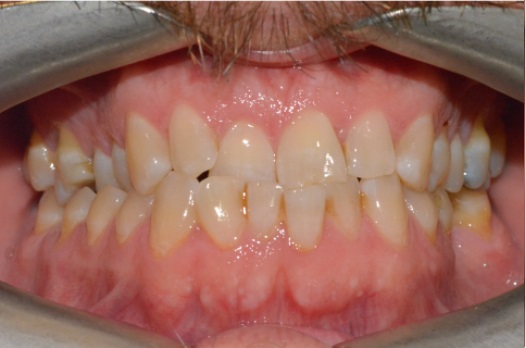 B&A Invisalign before 9