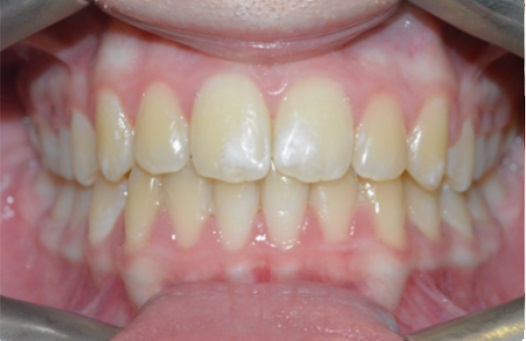 B&A fixed braces after 1