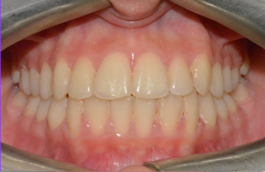 B&A fixed braces after 2