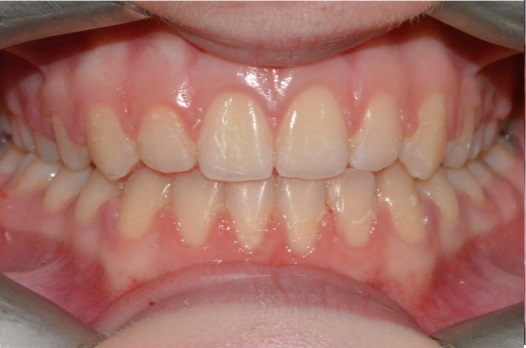 B&A fixed braces after 3