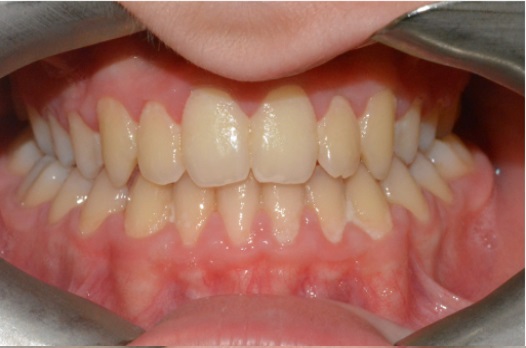 B&A fixed braces after 4