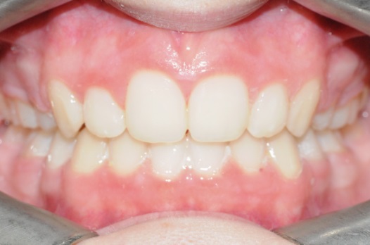 B&A fixed braces after 5
