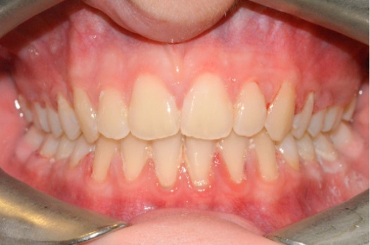 B&A fixed braces after 6