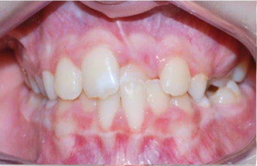 B&A fixed braces before 1