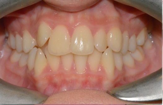 B&A fixed braces before 2