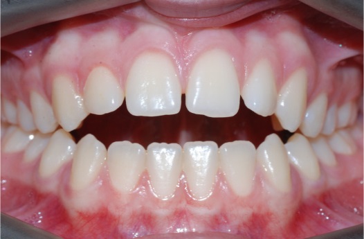 B&A fixed braces before 3