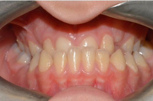 B&A fixed braces before 4