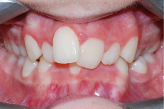 B&A fixed braces before 5