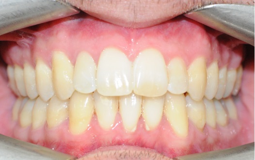 Invisalign page after 1