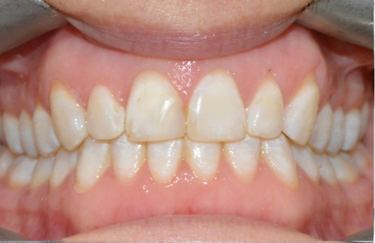 Invisalign page after 2