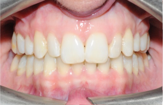 Invisalign page after 3