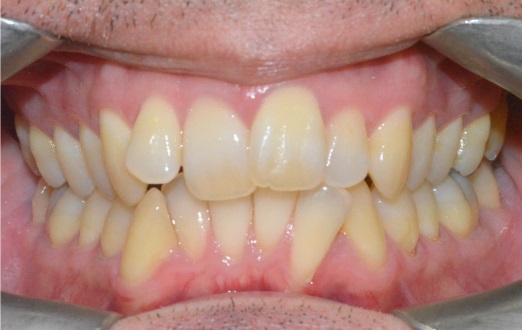 Invisalign page before 1