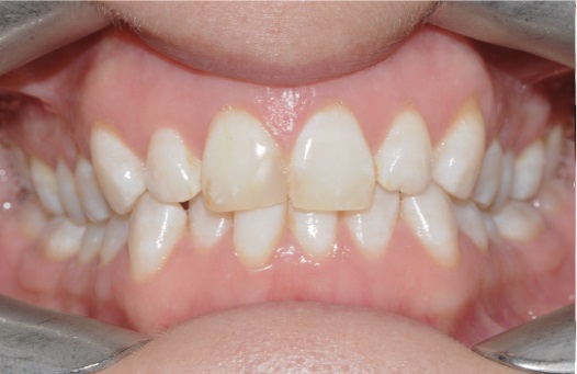 Invisalign page before 2