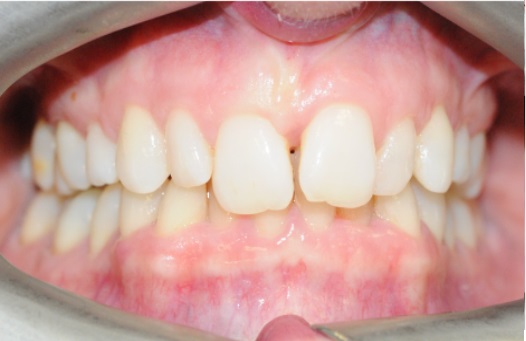Invisalign page before 3