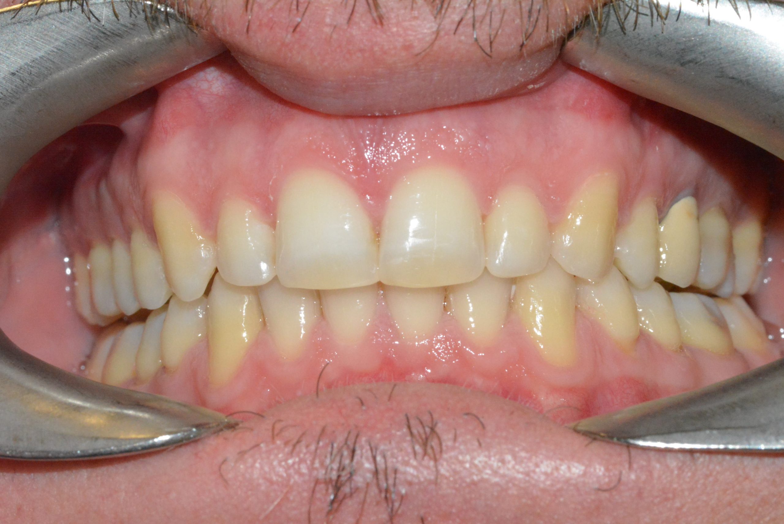 17633 before- invis (NEED CONSENT)