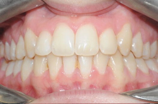 teeth_1after