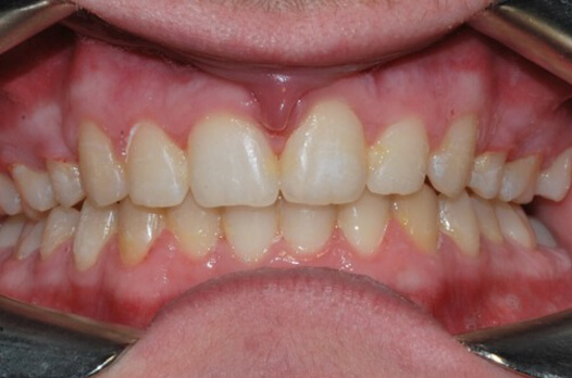 teeth_1before