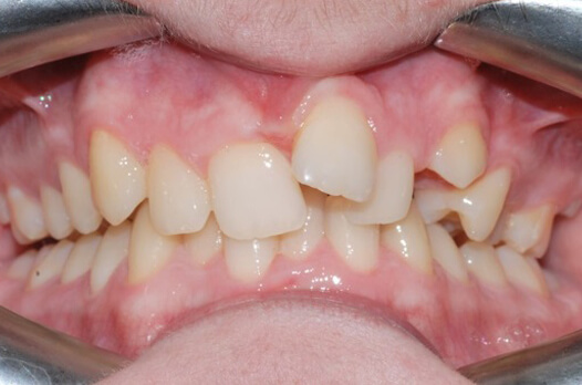 teeth_2before