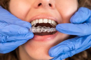 how long does invisalign take? a realistic treatment timeline