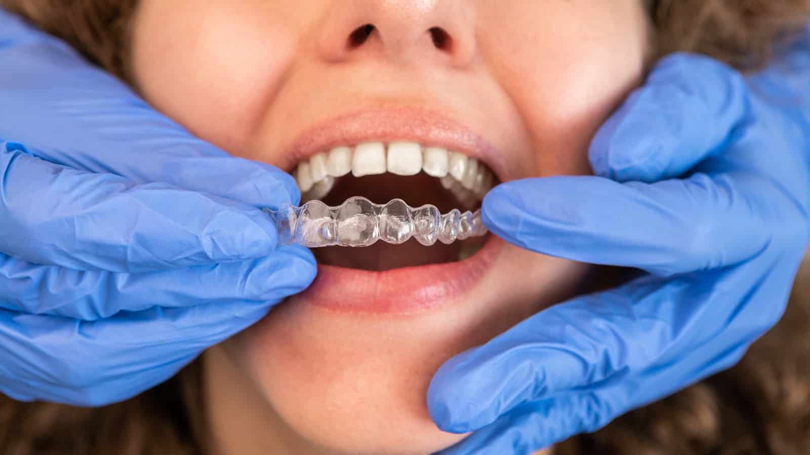 how long does invisalign take? a realistic treatment timeline