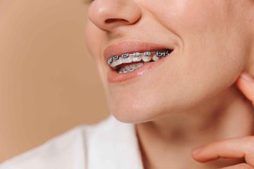 Clear aligners vs braces comparison for teeth straightening
