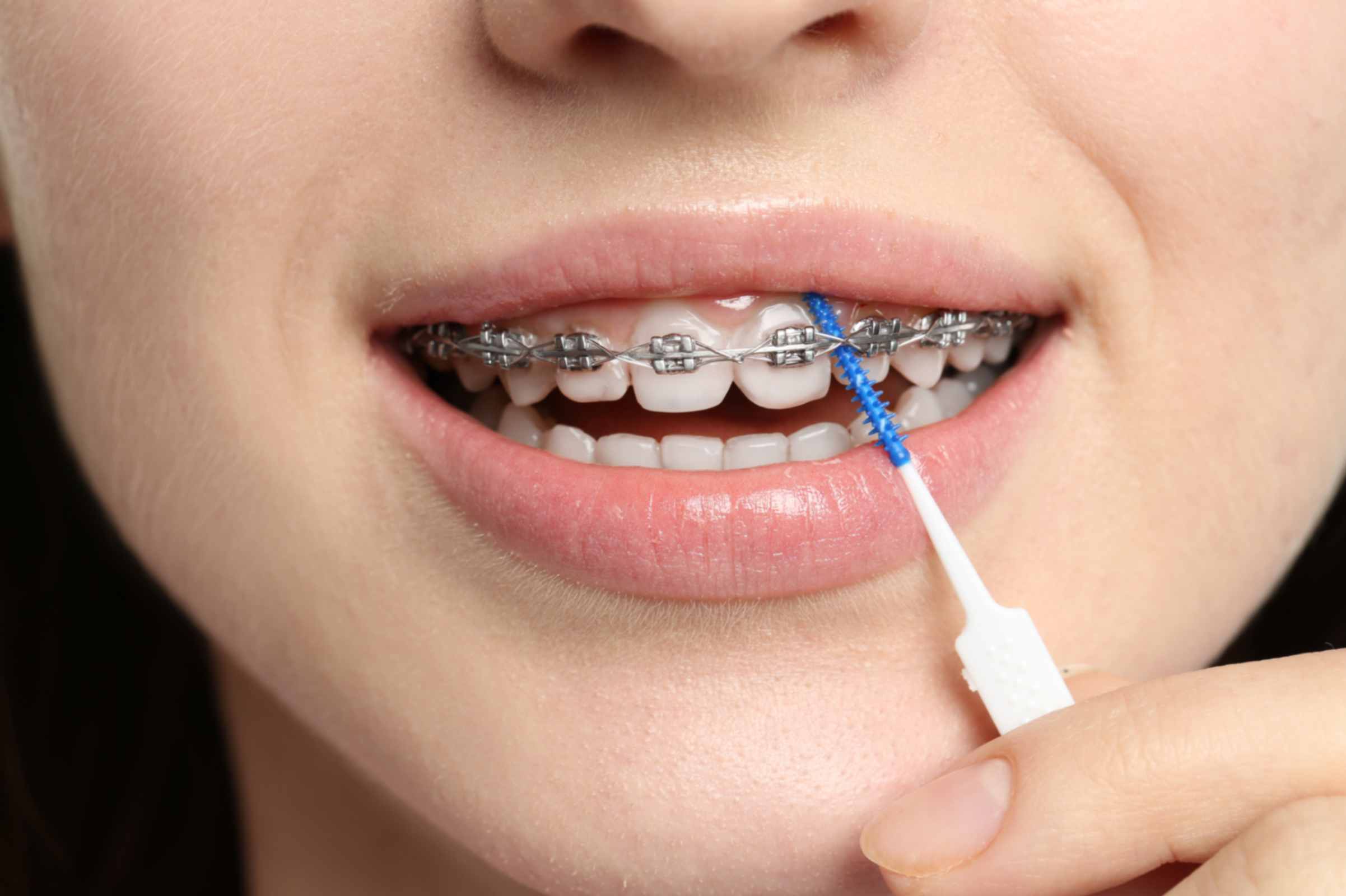 person-cleaning-braces-with-interdental-brush-from professional